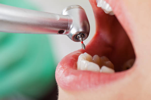 Best Emergency Tooth Extraction in Laymantown, VA